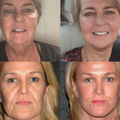 Celthera's Moritek Collection Botox Mist