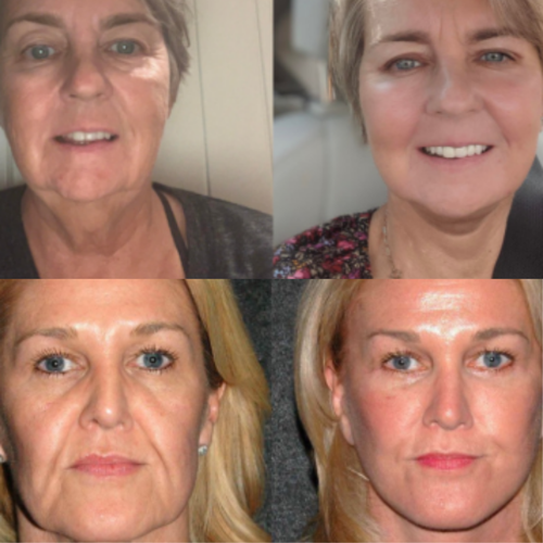 Celthera's Moritek Collection Botox Mist