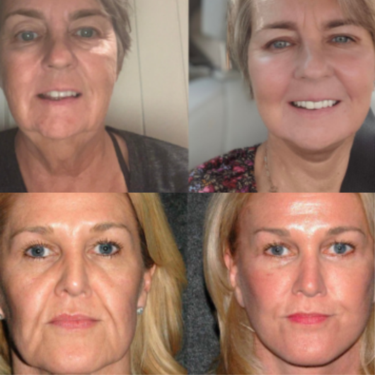 Celthera's Moritek Collection Botox Mist